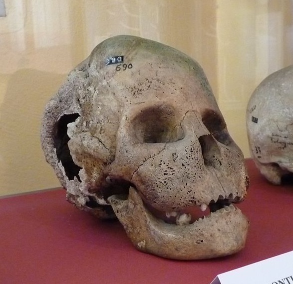 Leontiasis Ossea skull  in the museum