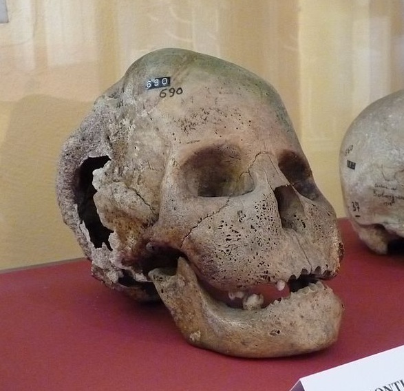 Leontiasis Ossea skull in the museum Leontiasis Ossea skull in the museum